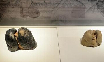 吸煙的肺與不吸煙的肺對比